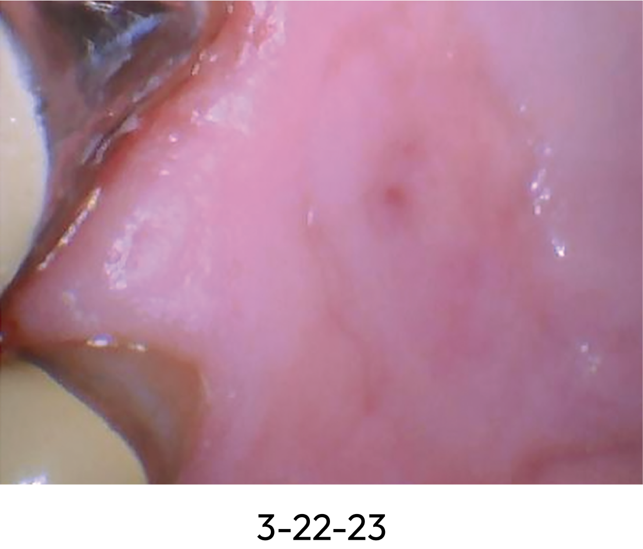 Benova Mouth Rinse for Healthcare Providers – Fast Relief for Oral Lesions